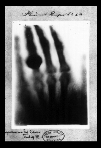 (Hand with Rings). Print of Wilhelm Röntgen's first  X-ray, of his wife's hand, taken on 22 December 1895